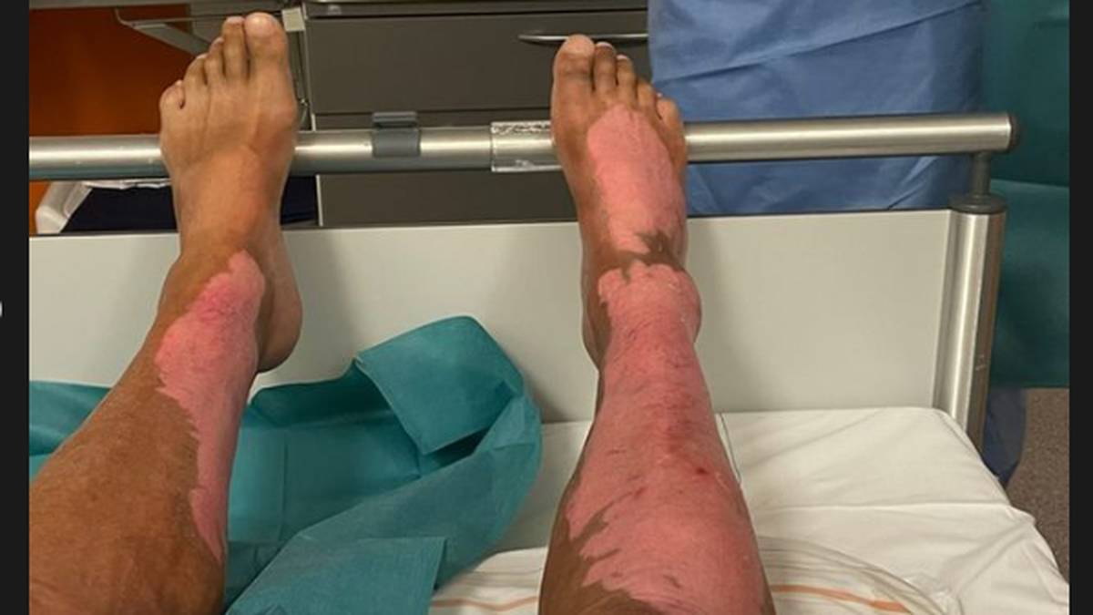 Norbert Dickel zeigt seine verbrannten Beine auf Instagram