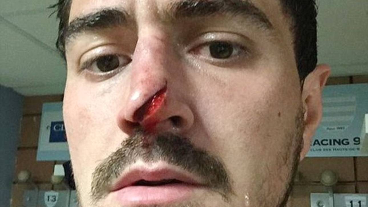 Rugby-Star zeigt aufgeschlitzte Nase