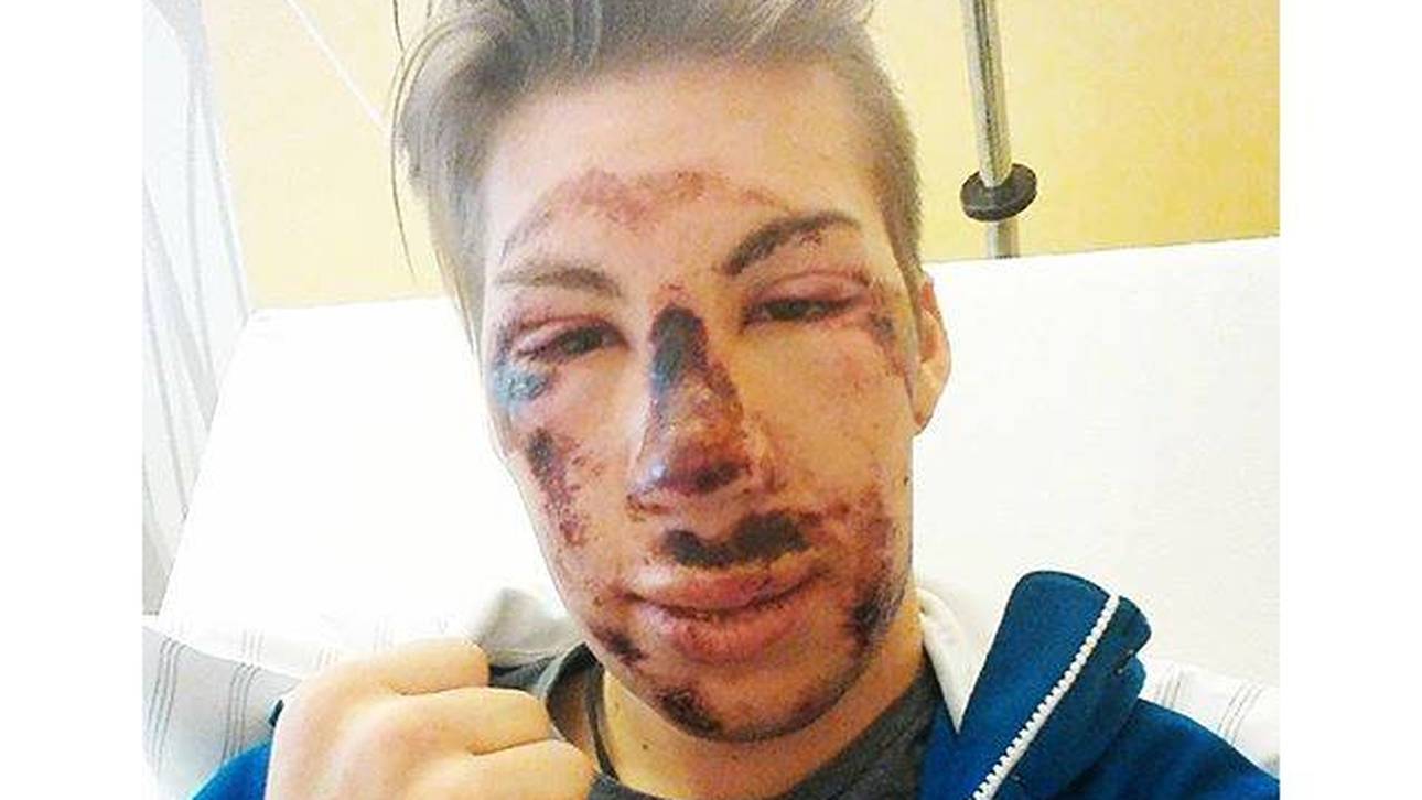 Gestürzter Diethart postet Schock-Foto