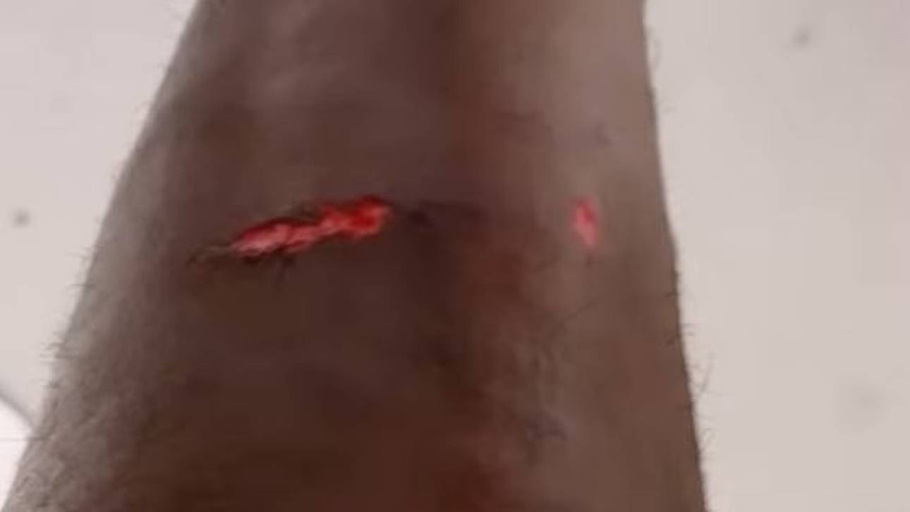 Alphonso Davies zeigt seine Verletzung nach dem Spiel gegen Marokko