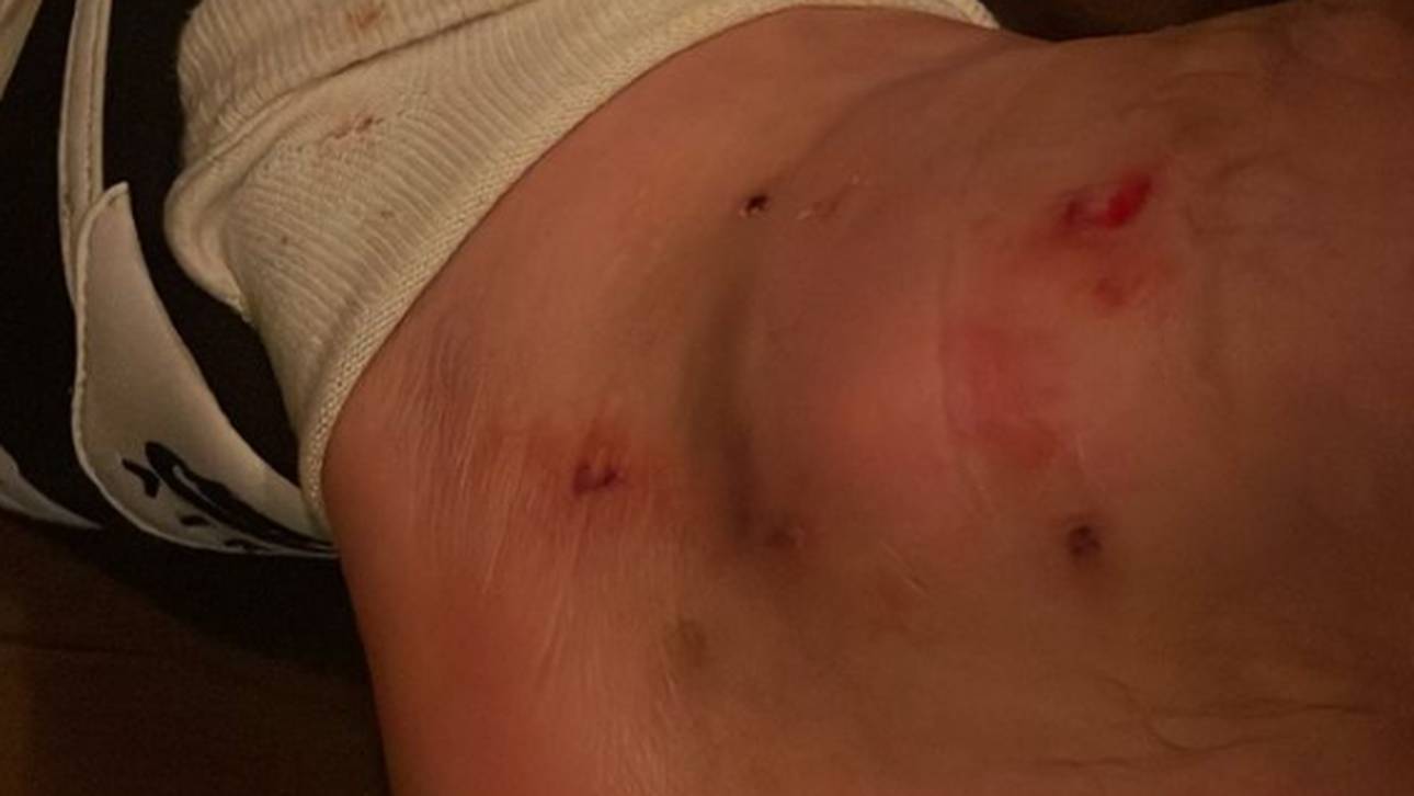 Kein Elfer? Kruse zeigt dicken Knöchel