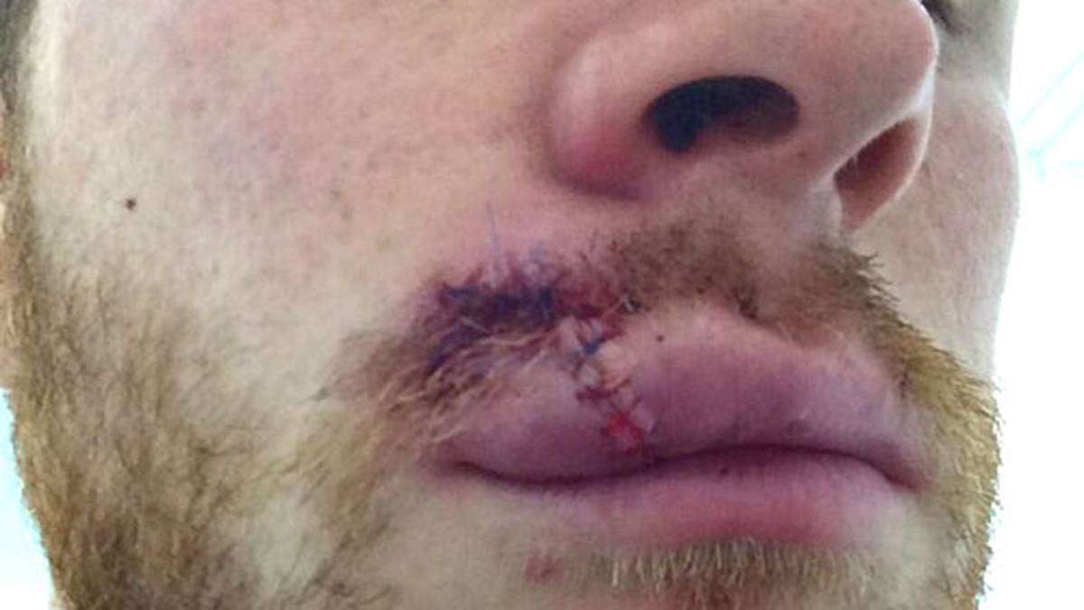 Einen Riesen-Cut in seiner Oberlippe trägt Mark Reynolds vom FC Aberdeen nach einem Zweikampf mit seinem Gegenspieler davon. Auf Twitter schreibt er dazu: "Meine Karriere als Model ist beendet, bevor sie begann." Welche Leistung die Ärzte vollbringen, wird beim nächsten Bild deutlich...aber Vorsicht, die Aufnahme ist nichts für schwache Gemüter (Copyright: twitter@reyn01ds)