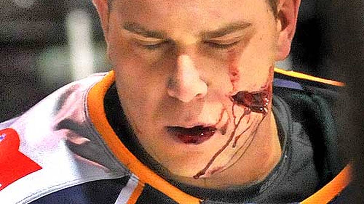 Zu einer absoluten Schrecksekunde kommt es in einer unterklassigen Eishockey-Liga in Kanada. Im Spiel der Ligue Nord-Americaine de Hockey zwischen den Thetford Mines Isothermic gegen die Trois Vikings wird Isothermic-Kapitän Sebastien Courcelles mit einem Schlittschuh die Wange aufgeschlitzt. Eine absolute Horrorverletzung                     