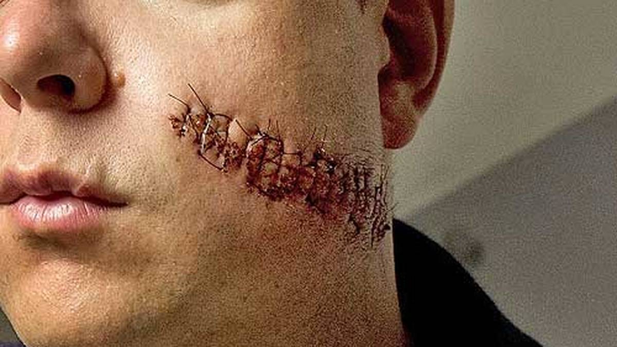 Die Horrorverletzung hält ihn allerdings nicht davon ab, sich wenige Tage später aufs Eis zu begeben - dann allerdings mit komplettem Gesichtsschutz
                  
                  