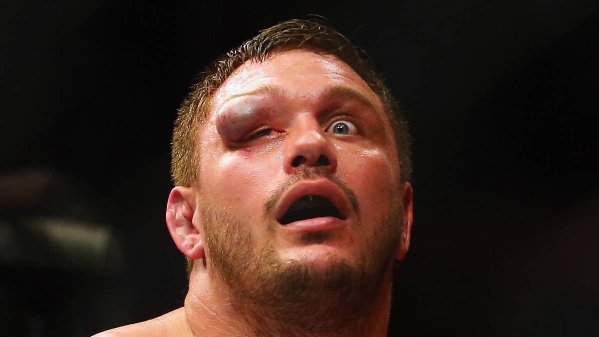 Bei Matt Mitrione dagegen ist der Gegner für dieses riesige Hämatom verantwortlich. Travis Browne sorgt mit gezielten Schlägen auf Mitrones Auge für die riesige Schwellung. 