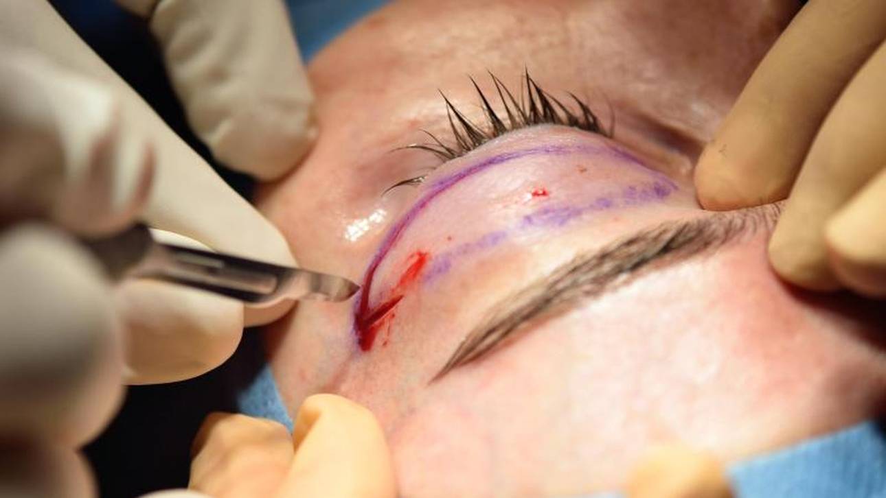 Werbeverbot von Schönheits-OPs