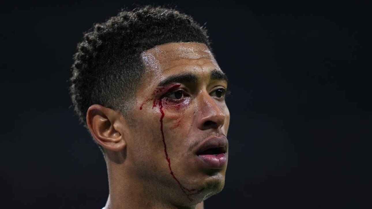 Jude Bellingham blutete im Gesicht