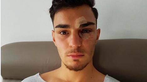 Kaan Ayhan mit Augenverletzung