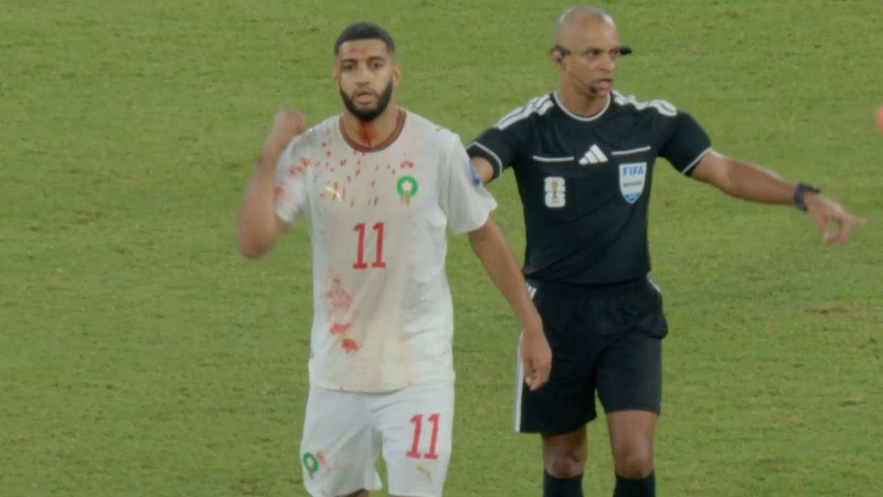 WM 2026: Heftige Blut-Bilder um Bayern-Flirt