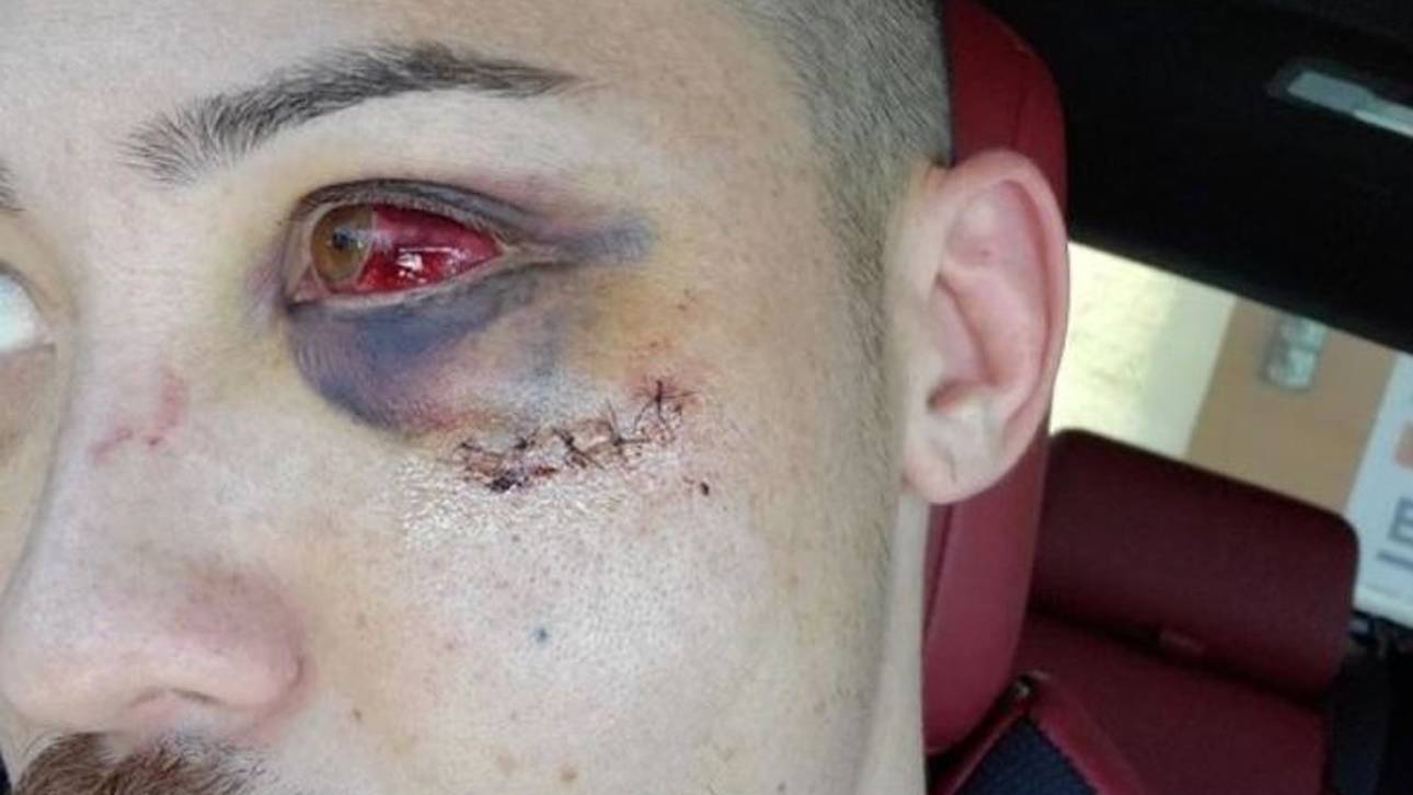 Boston Salmon zeigte auf Instagram Bilder seiner Horrorverletzung