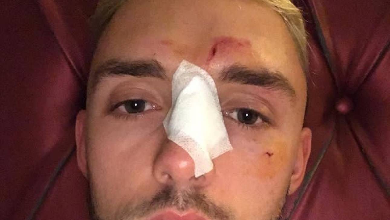 Jonas Folger bricht sich im Training die Nase