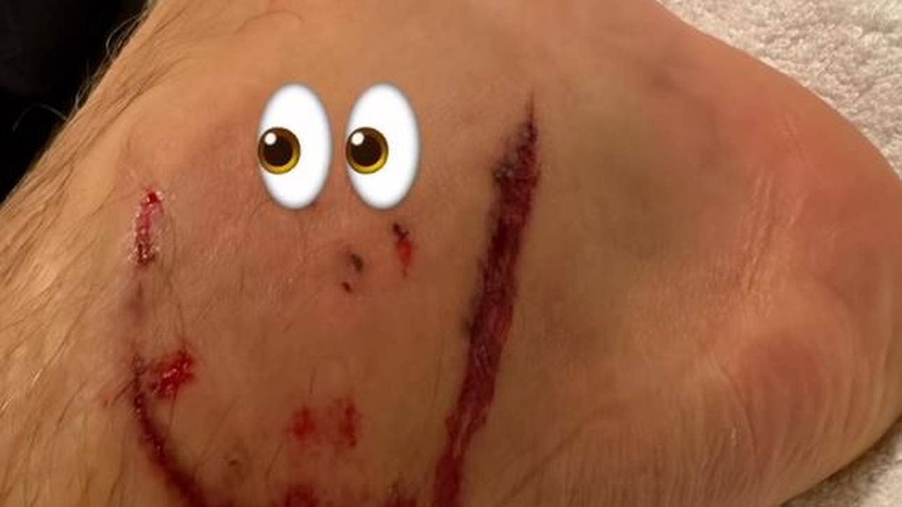 Leon Goretzka nahm seine Verletzung gegen Mexiko mit Humor