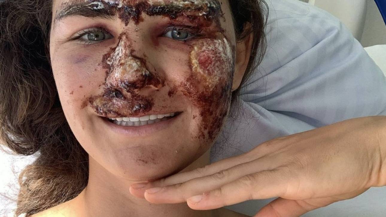 Nächste Schock-Diagnose für Ski-Star