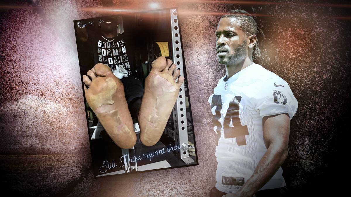 ANTONIO BROWN: Der Star-Receiver hat sich in einer Kältekammer verletzt. Brown, damals noch bei den Oakland Raiders, hatte laut eigenen Angaben nicht das passende Schuhwerk dabei und zog sich dicke Blasen an beiden Füßen zu