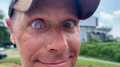 Ryan Gibson trägt das Wappen des FC Bayern München als Glasauge. Der Grund dafür war ein tragisches Schicksal.