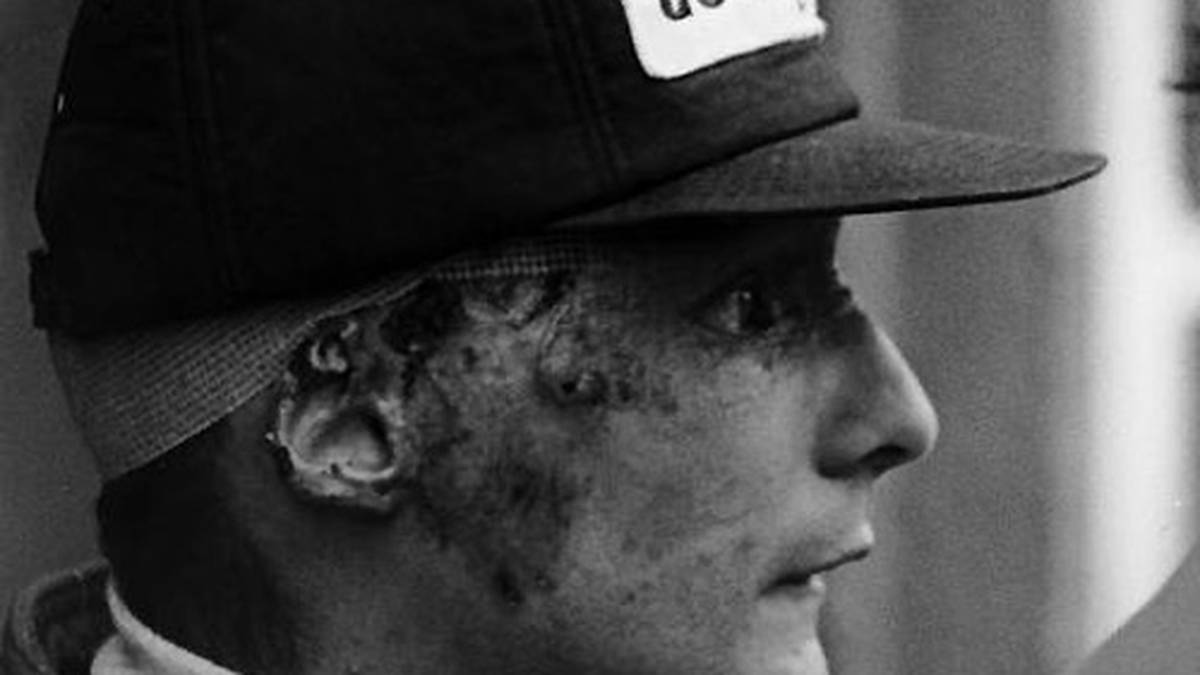 Im Krankenhaus fällt Lauda ins Koma. Gefährlicher als die Brandwunden sind der giftige Rauch der Kunststoffkarosserie und der Löschschaum, die zu Lungenverätzungen führen. Laudas Zustand ist kritisch, er erhält die Krankensalbung. Doch Lauda gibt nicht auf 