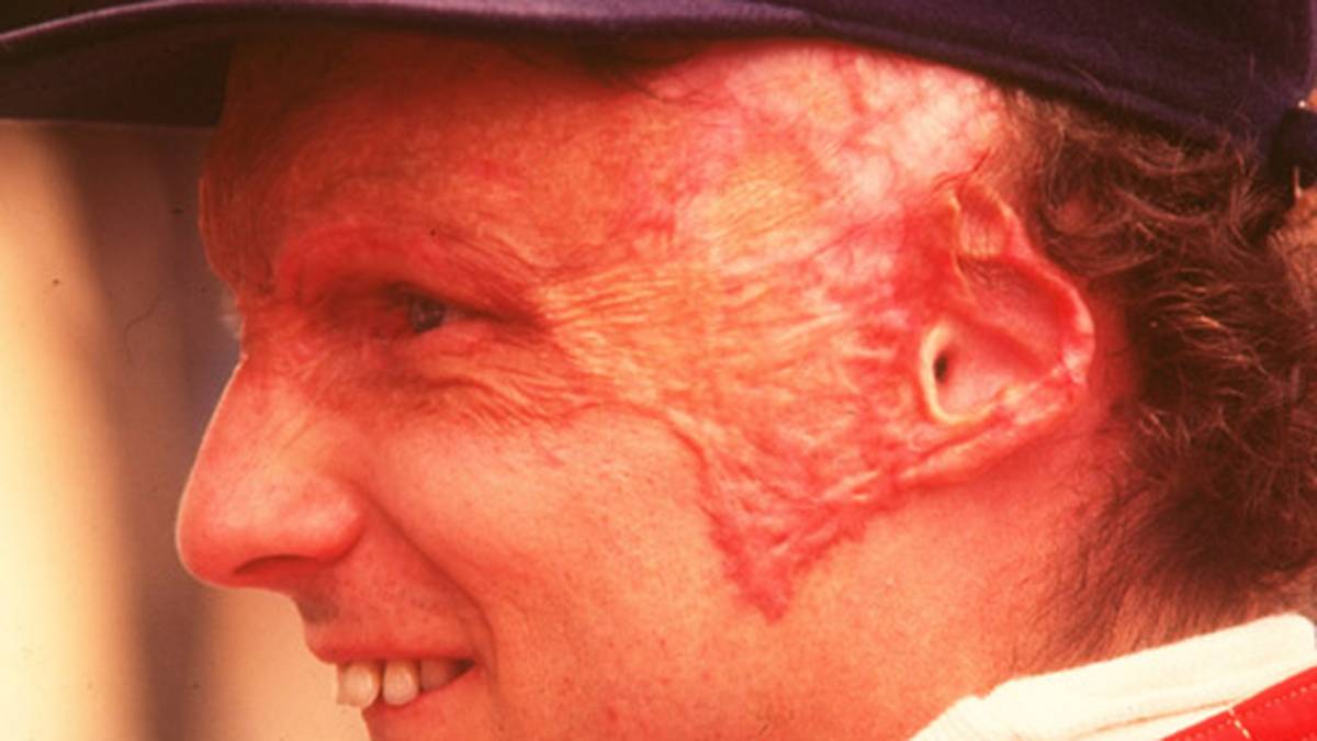 Nur 42 Tage später kehrt er ins Cockpit zurück. Schwer gezeichnet ist er in Monza wieder mit von der Partie, wegen der Brandverletzungen um die Augen kann er kaum blinzeln, seine Sicht ist eingeschränkt. Trotzdem hält er durch. In der Folgezeit muss er zahlreiche Operationen und Transplantationen über sich ergehen lassen