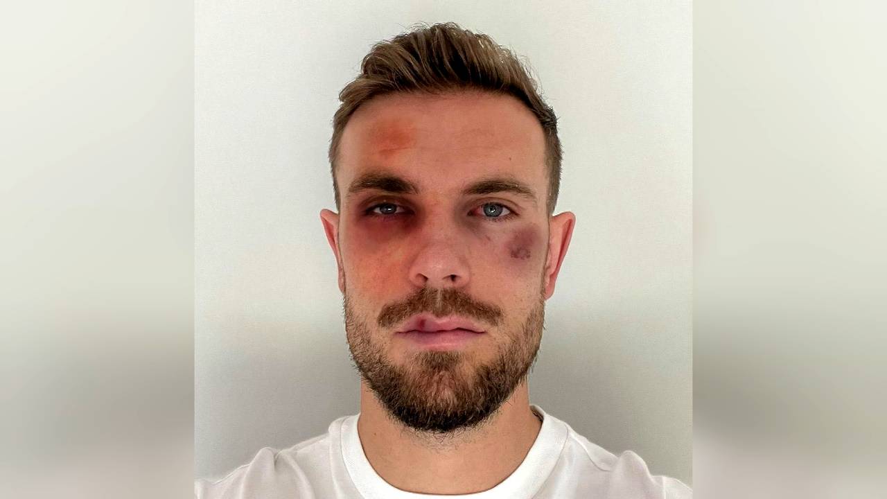 Premier League: Fußballstars zeigen sich mit Verletzungen für gute Sache