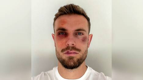 Einige Fußballstars aus der Premier League zeigen sich mit Verletzungen im Gesicht. Hintergrund ist eine Aktion gegen Online-Missbrauch.