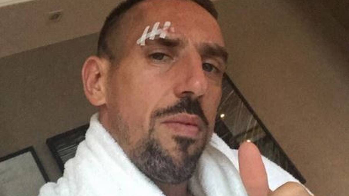 Franck Ribery erlitt am Donnerstag im Training eine Platzwunde
