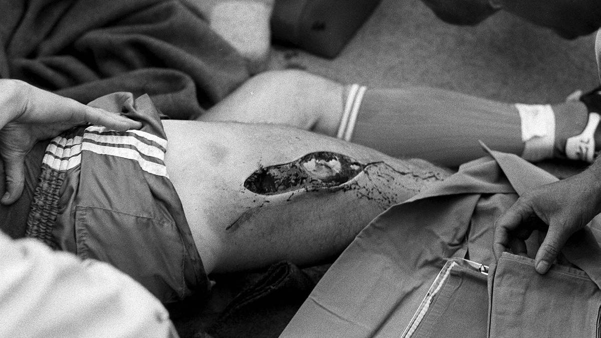 Achtung: Nichts für schwache Nerven! Der damalige Bielefelder Lienen trägt von dem Foul eine 20 Zentimeter lange Fleischwunde davon. Die längste Wunde der Bundesliga hat ein Nachspiel