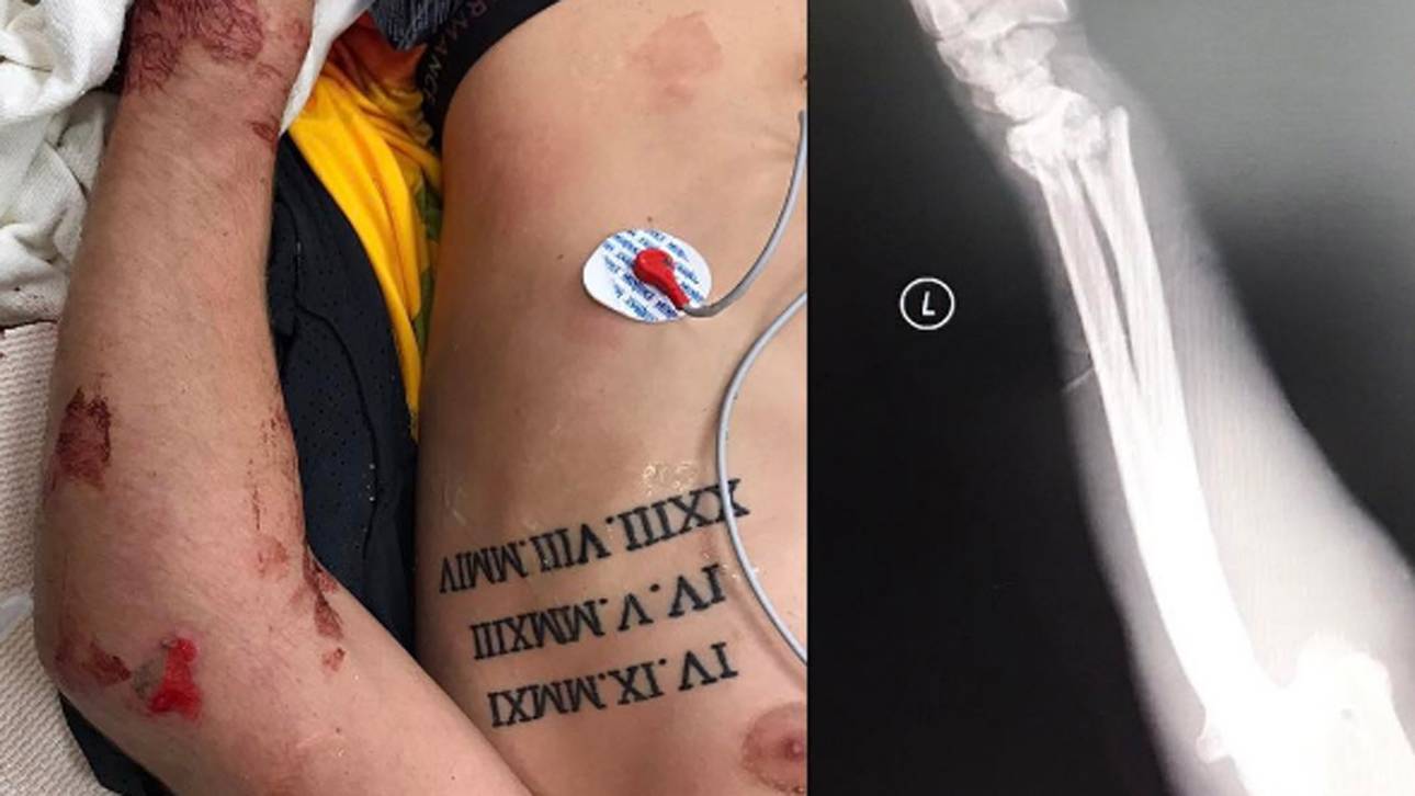 Horrorsturz: Roczen zeigt Blessuren