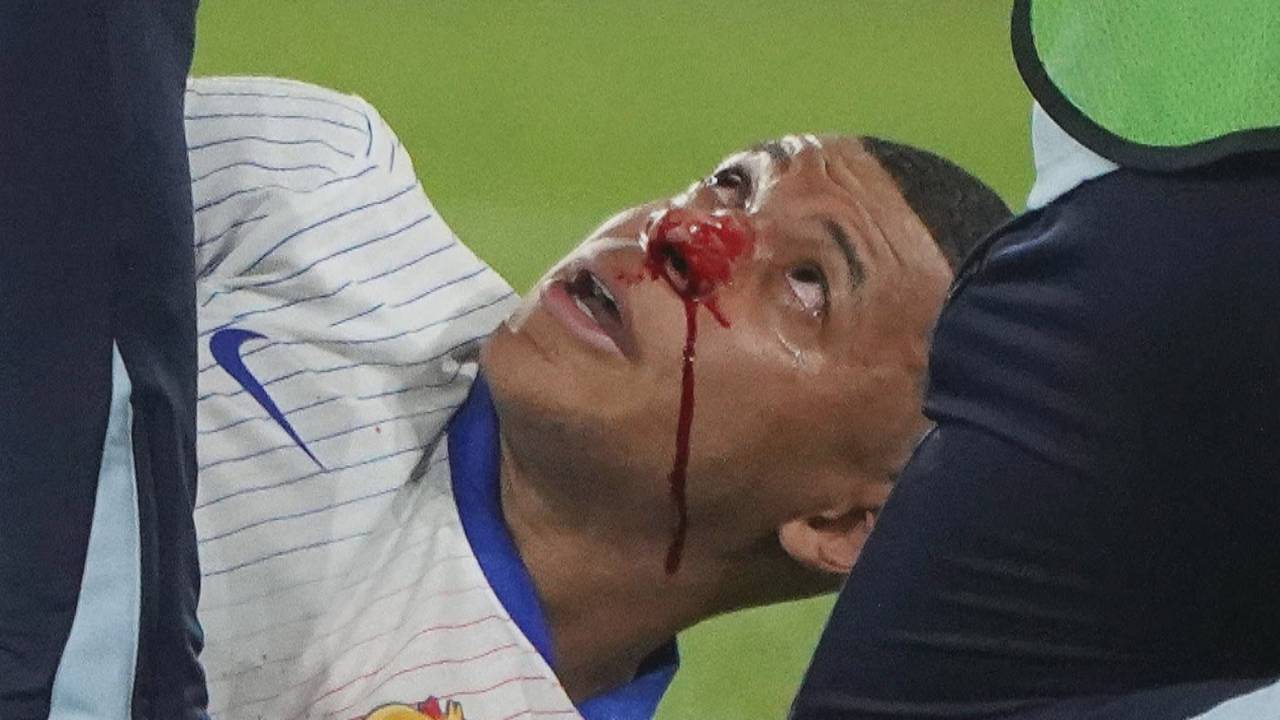 EM 2024: Kylian Mbappé droht gegen die Niederlande auszufallen