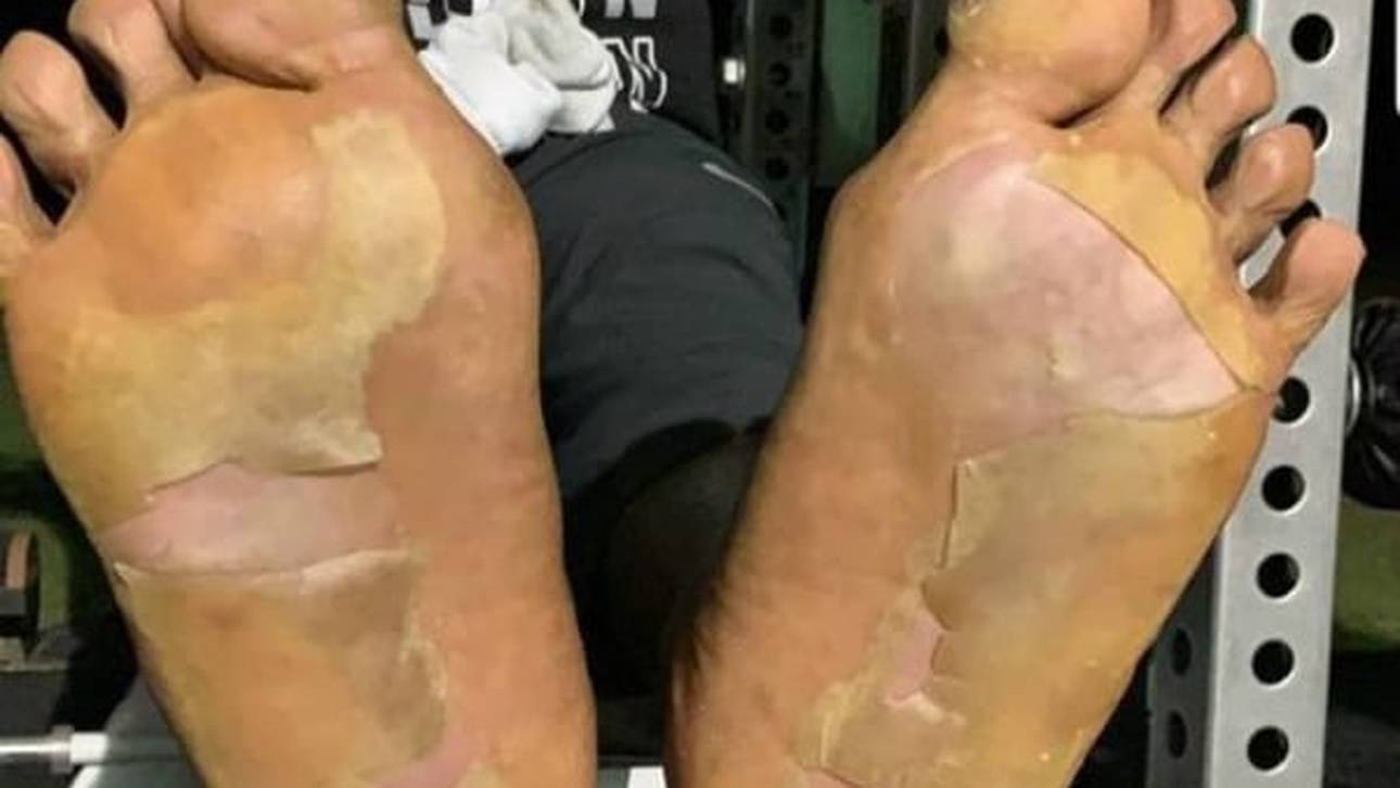 So sahen die Füße von Antonio Brown nach dem Kryo-Fail aus