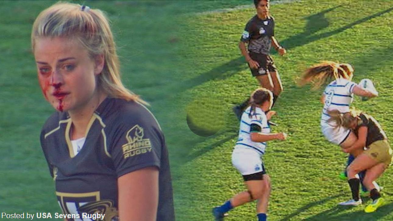 Rugby-Spielerin trotzt Verletzung