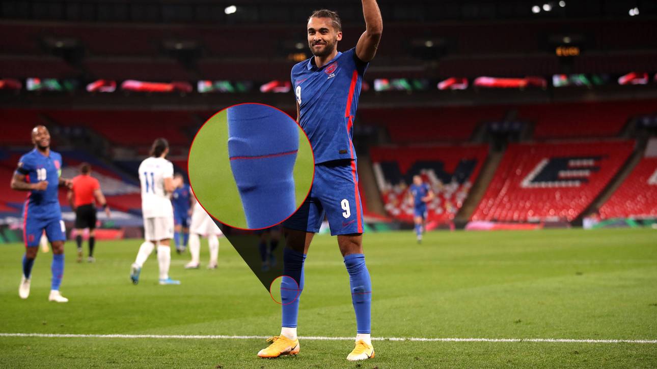Dominic Calvert-Lewin wartet mit recht kuriosen Schienbeinschützern auf