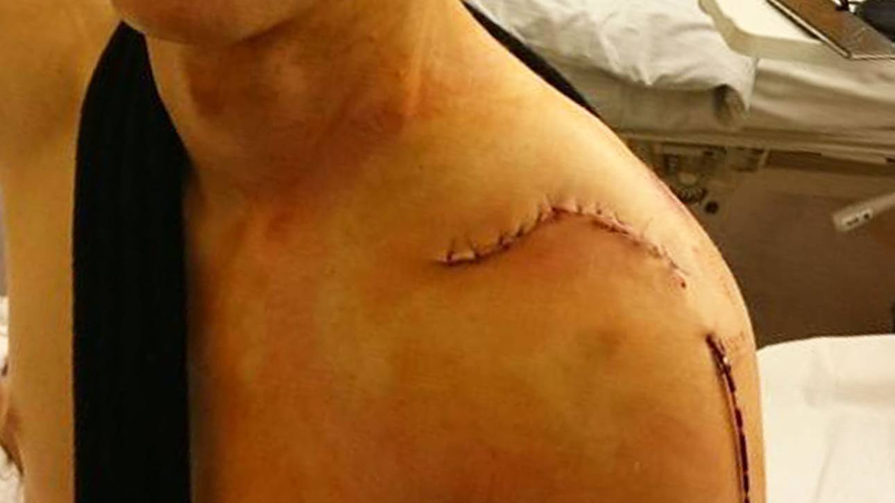 Martin präsentiert seine Narbe