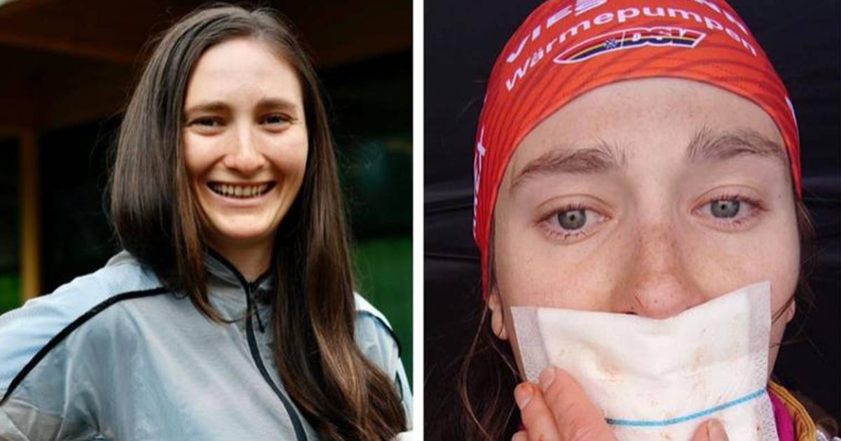 Resilient Biathlete Survives Tongue Transplant After Serious Accident