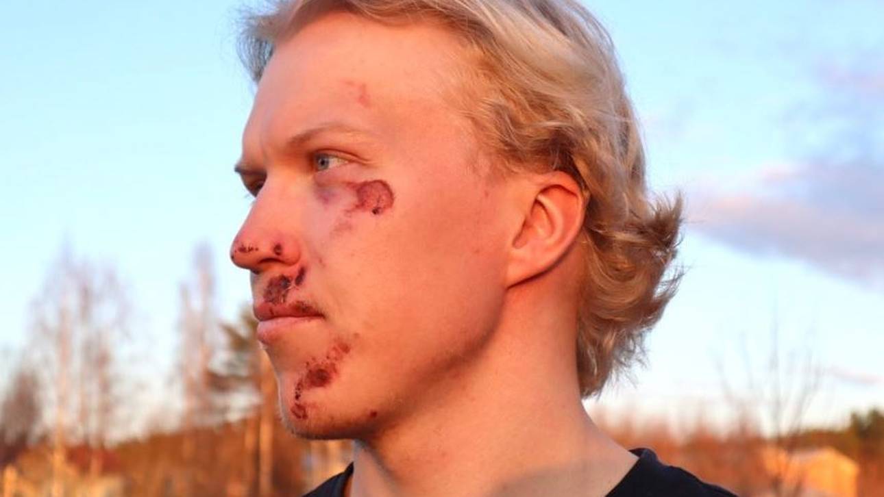 Biathlon-Talent übersteht üblen Unfall