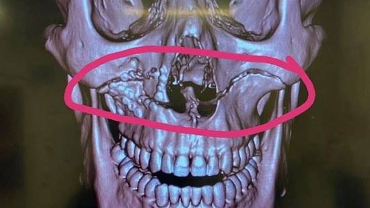 Rugby-Star zeigt Horror-Verletzung