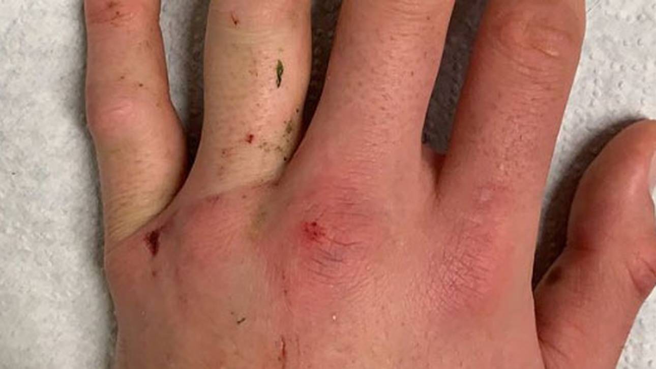 Mats Hummels verletzte sich im Spiel bei der TSG Hoffenheim an der Hand