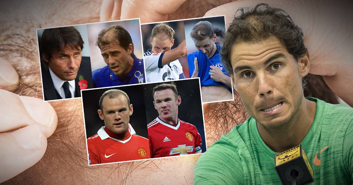 Haarig Auch Nadal Setzt Auf Transplantation Sport1 Bildergalerie