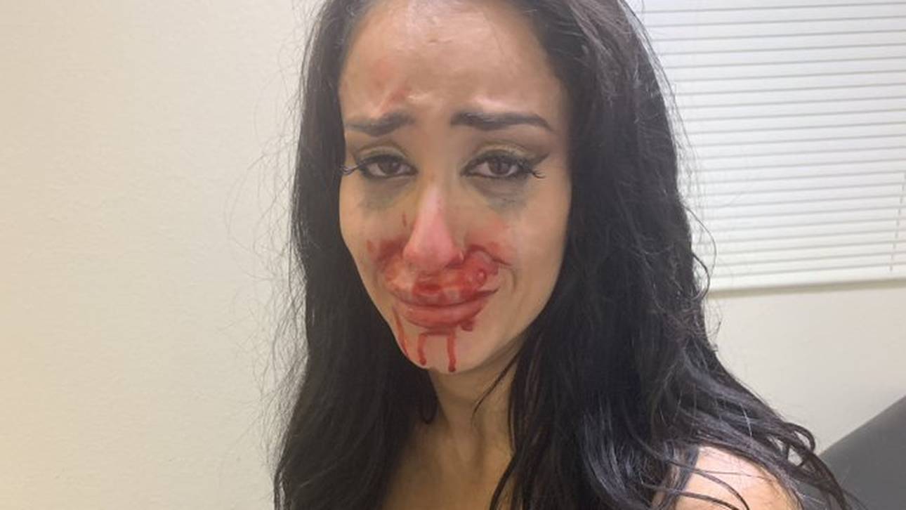 Blutige Panne bei WWE-Frauenkampf