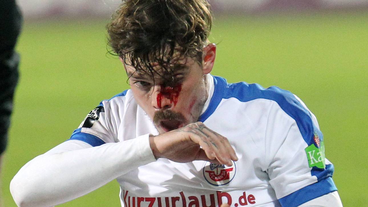 Hansa-Profi: Siebenfacher Nasenbruch