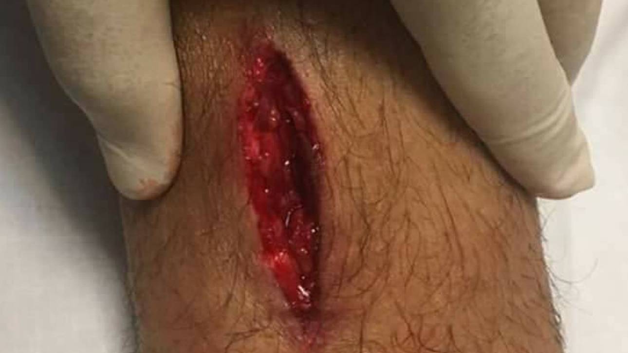 Rom-Profi zeigt tiefe Fleischwunde