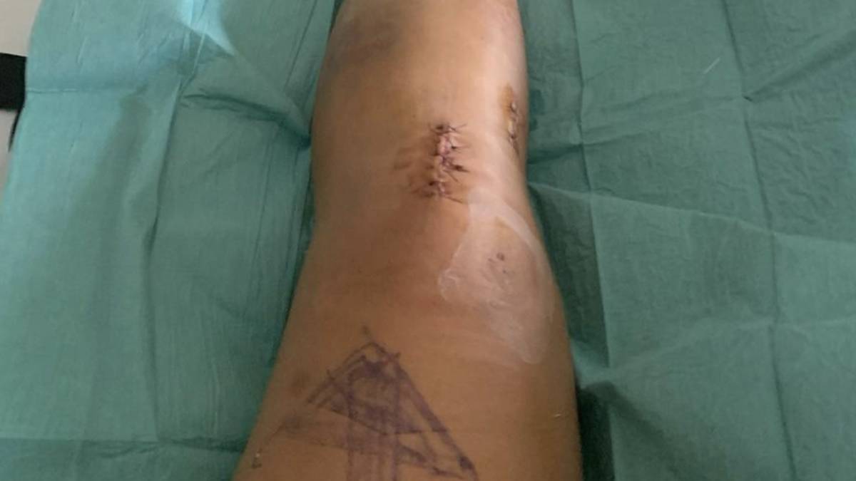 Alice Merryweather hat schwere Verletzungen am linken Bein erlitten
