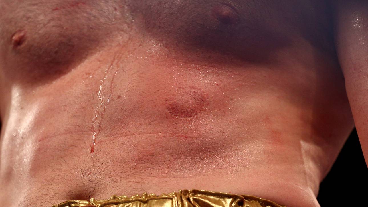 David Price hatte nach dem Kampf Bissspuren an der Brust