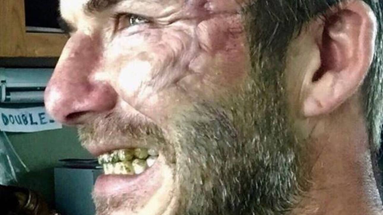 Beckham schockt Fans mit Narbe