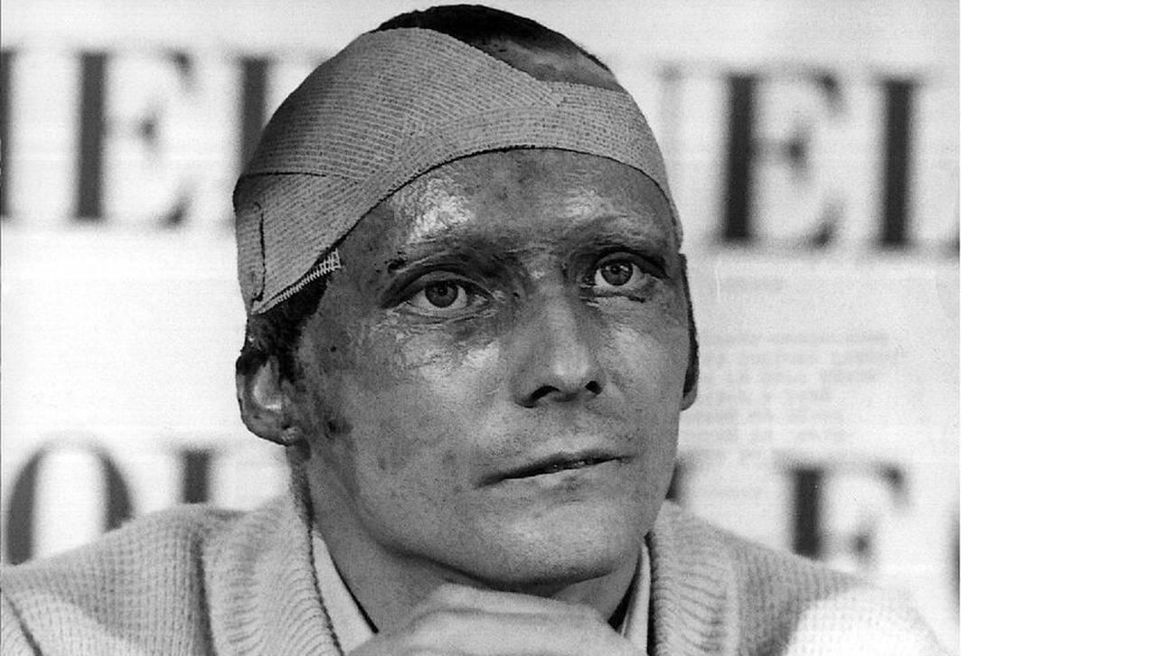 Niki Lauda bei einer Pressekonferenz nach seinem Feuerunfall 1976