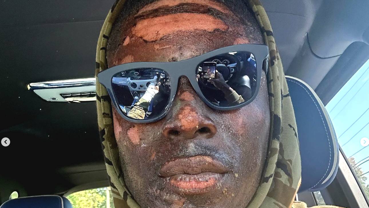 David Njoku zeigt das Ausmaß seiner Verletzungen