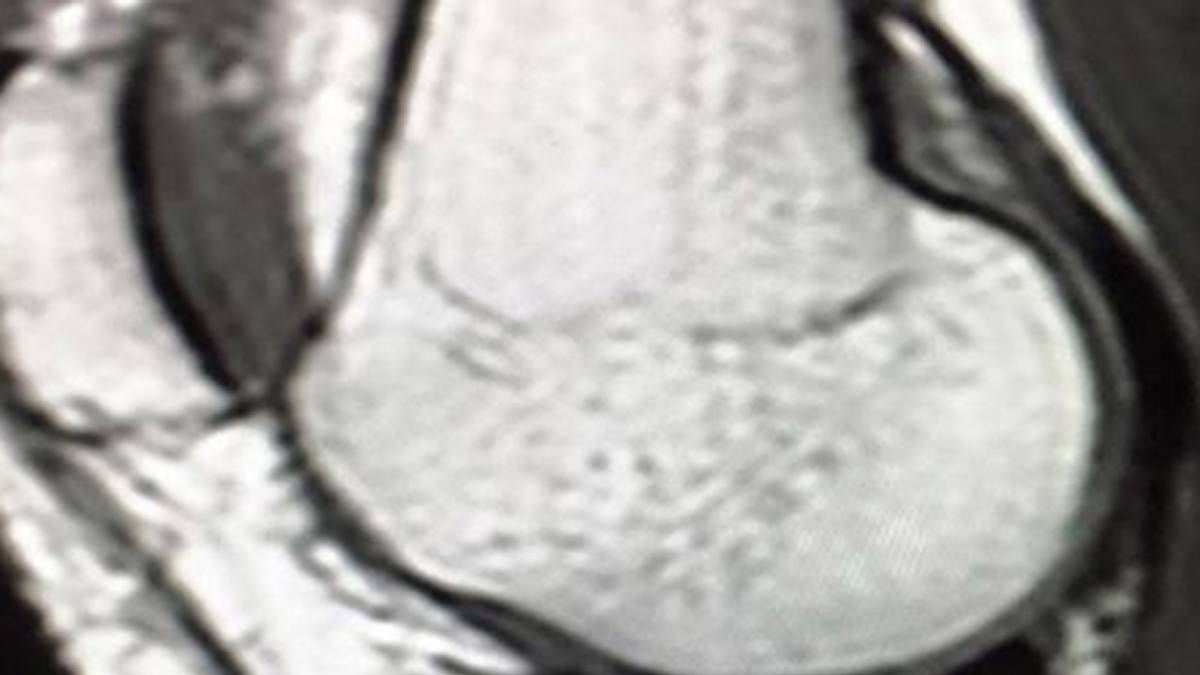 Die Kritik lässt Vonn natürlich nicht auf sich sitzen und feuert mit Giftpfeilen zurück: "Jeder denkt, es war nur Drama und Schauspiel - aber das ist Quatsch. Ich habe Schmerzen, aber ich kann trotzdem kämpfen", verteidigte sich die 31-Jährige und veröffentlichte sozusagen als Beweis am Sonntagabend auf Instagram ein Bild ihrer Kernspin-Untersuchung.  "Das MRI zeigt einen recht signifikanten Riss in meinem Schienbeinkopf. Das Innenband scheint wie der Rest meines Knies in Ordnung zu sein." Besonders in den Winter-Individualsportarten kommt es immer wieder zu Streitigkeiten. SPORT1 blickt in die Geschichte des Zickenzoffs