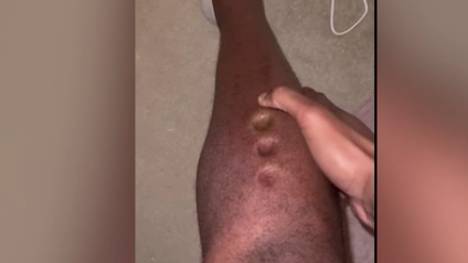 Lawrence Okoye ist olympischer Diskuswerfer und spielte mehrere Jahre in der NFL. Nun hat er auf Tiktok ein Video gepostet, in dem er sich Löcher ins Bein drückt. Das Video ist viral gegangen.